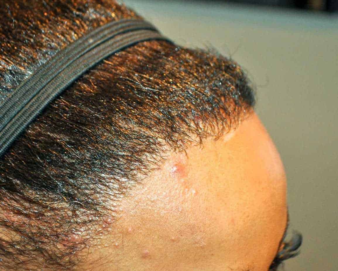 Women afro hair transplant after surgery