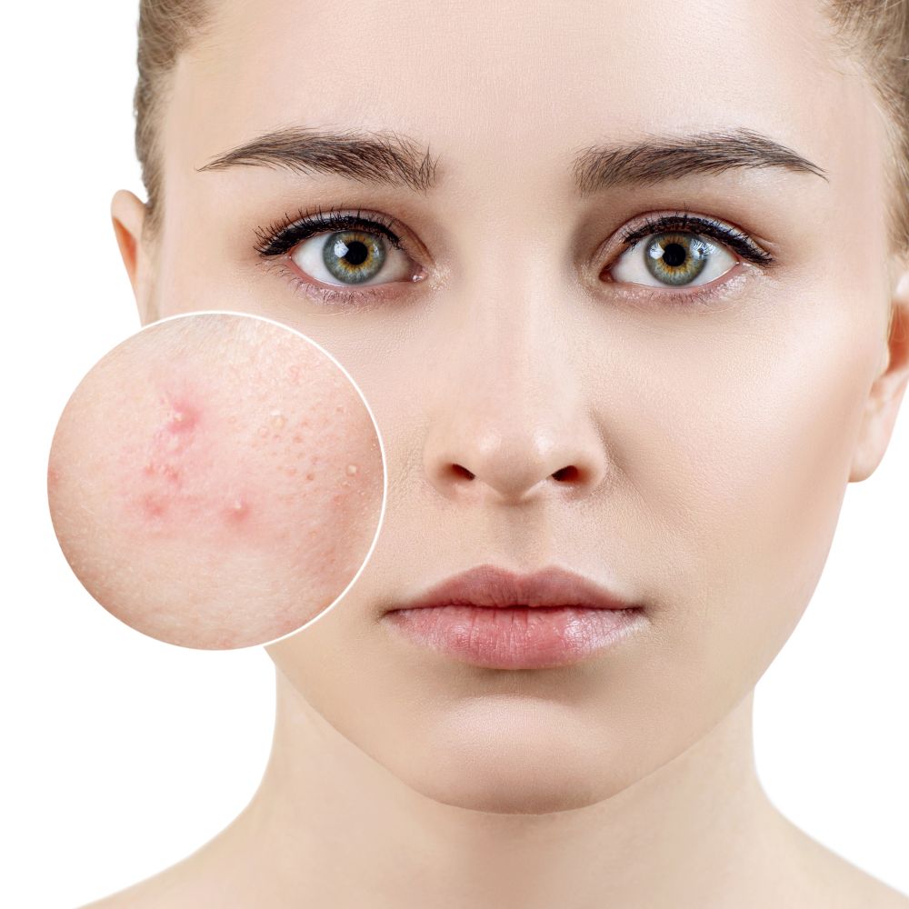 Acne as a side effect of Anavar
