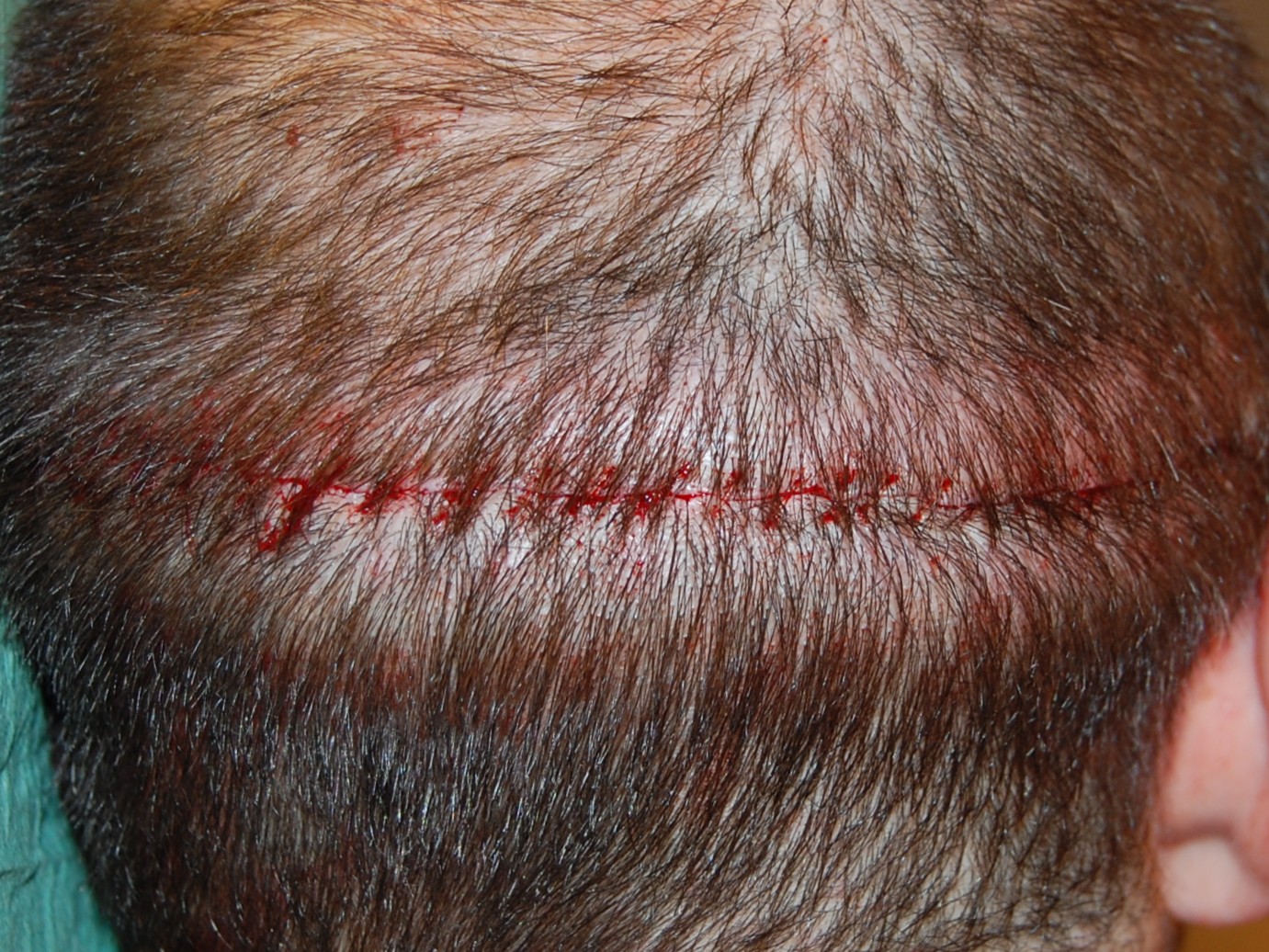FUT suture immediately after surgery