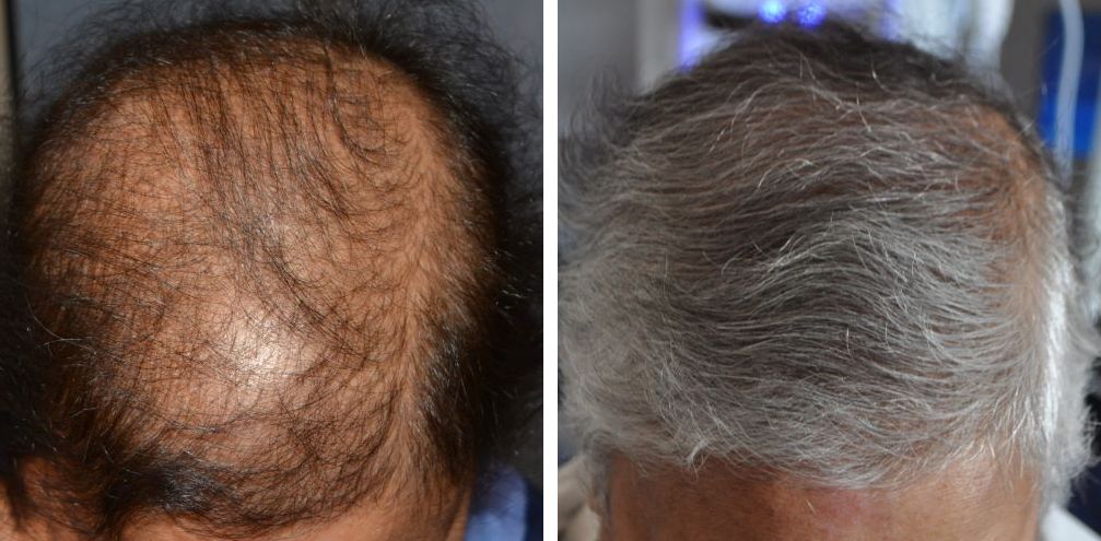 Female patient before and 8 months after FUT hair transplant