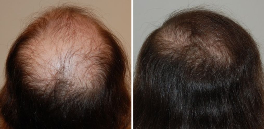 Female patient before and 8 months after crown hair transplant