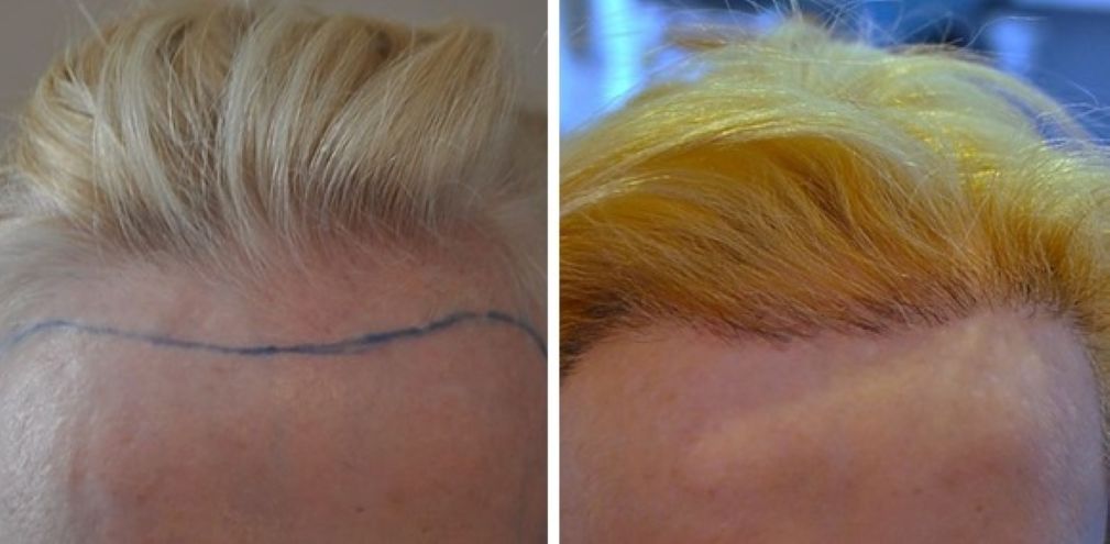 Female patient before and after 2400 grafts hairline hair transplant