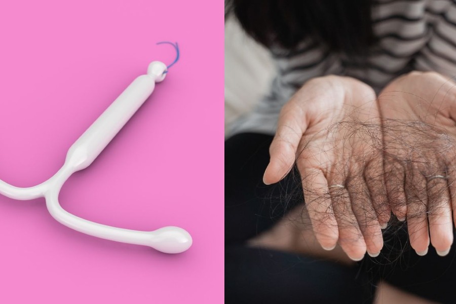 Mirena IUD Hair Loss Causes, Symptoms And Solutions