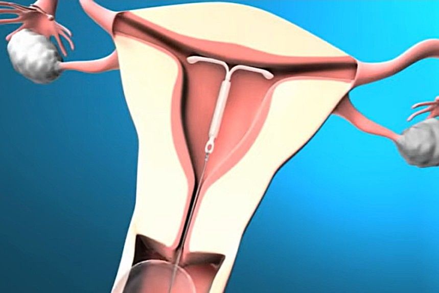 Mirena IUD device positioned inside the womb