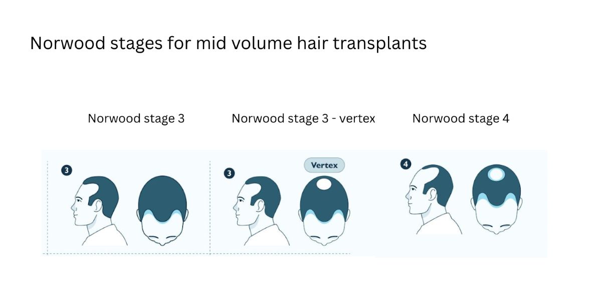 Norwood stages for mid volume hair transplants