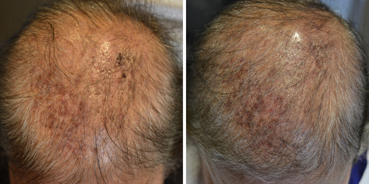 folliculitis patients