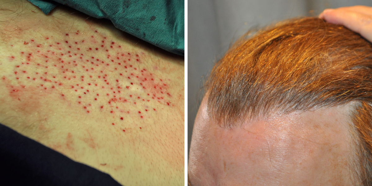 lower back hair to scalp body hair transplant