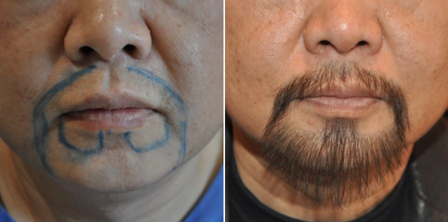 Before and 8 months after beard and moustache transplant.