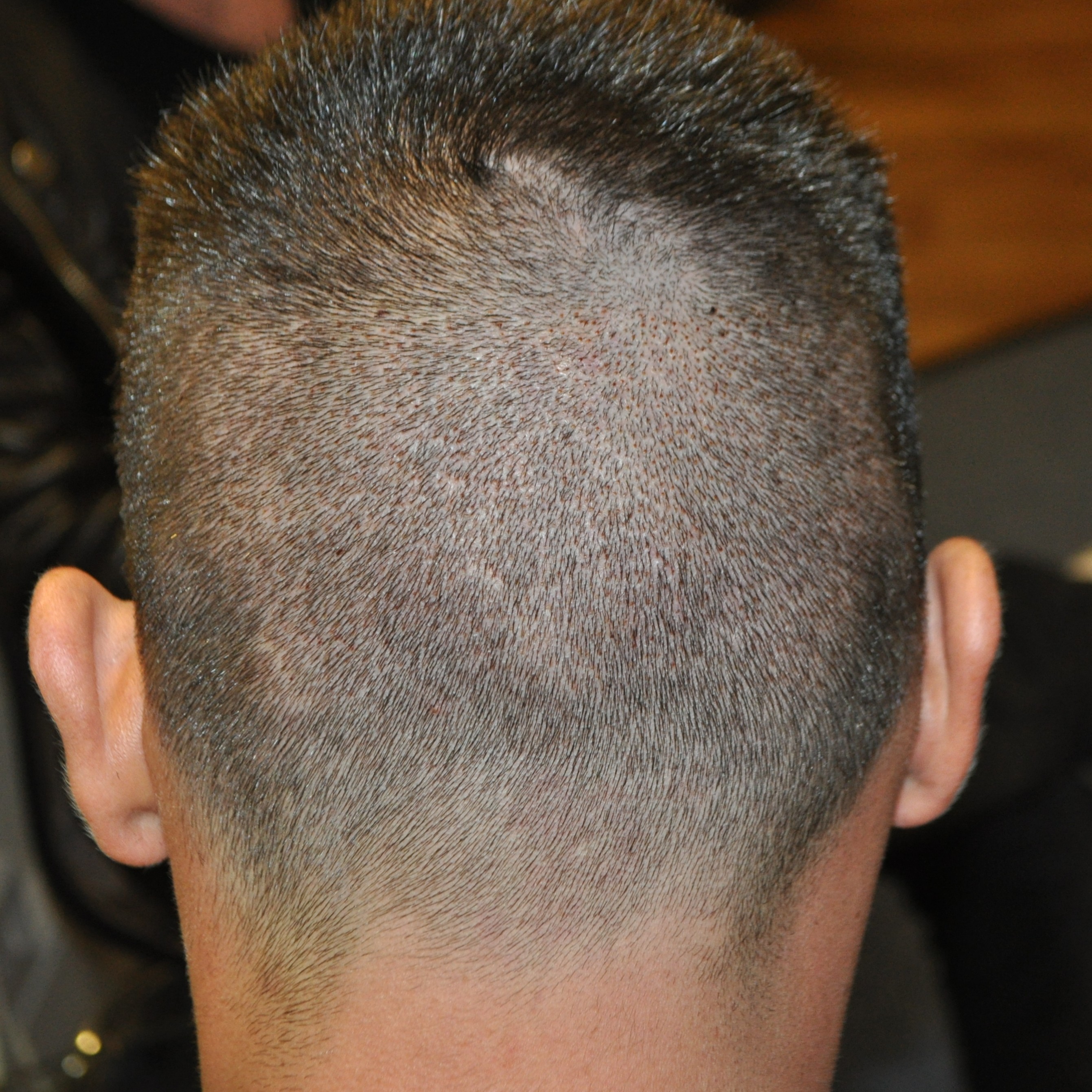 Donor area 3 days post FUE hair transplant surgery