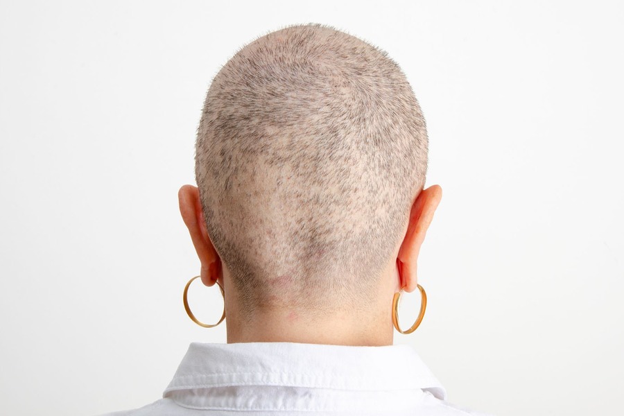 How To Stop Hair Loss At The Back Of The Head For Females