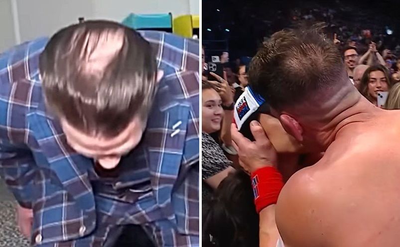 John Cena before and after hair transplant