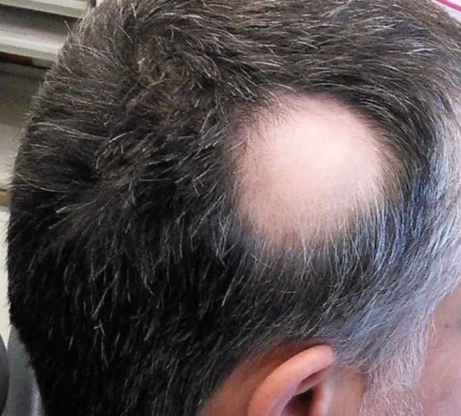 Man with alopecia areata