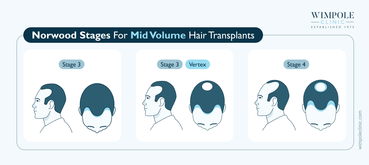 Norwood stages for mid volume hair transplants