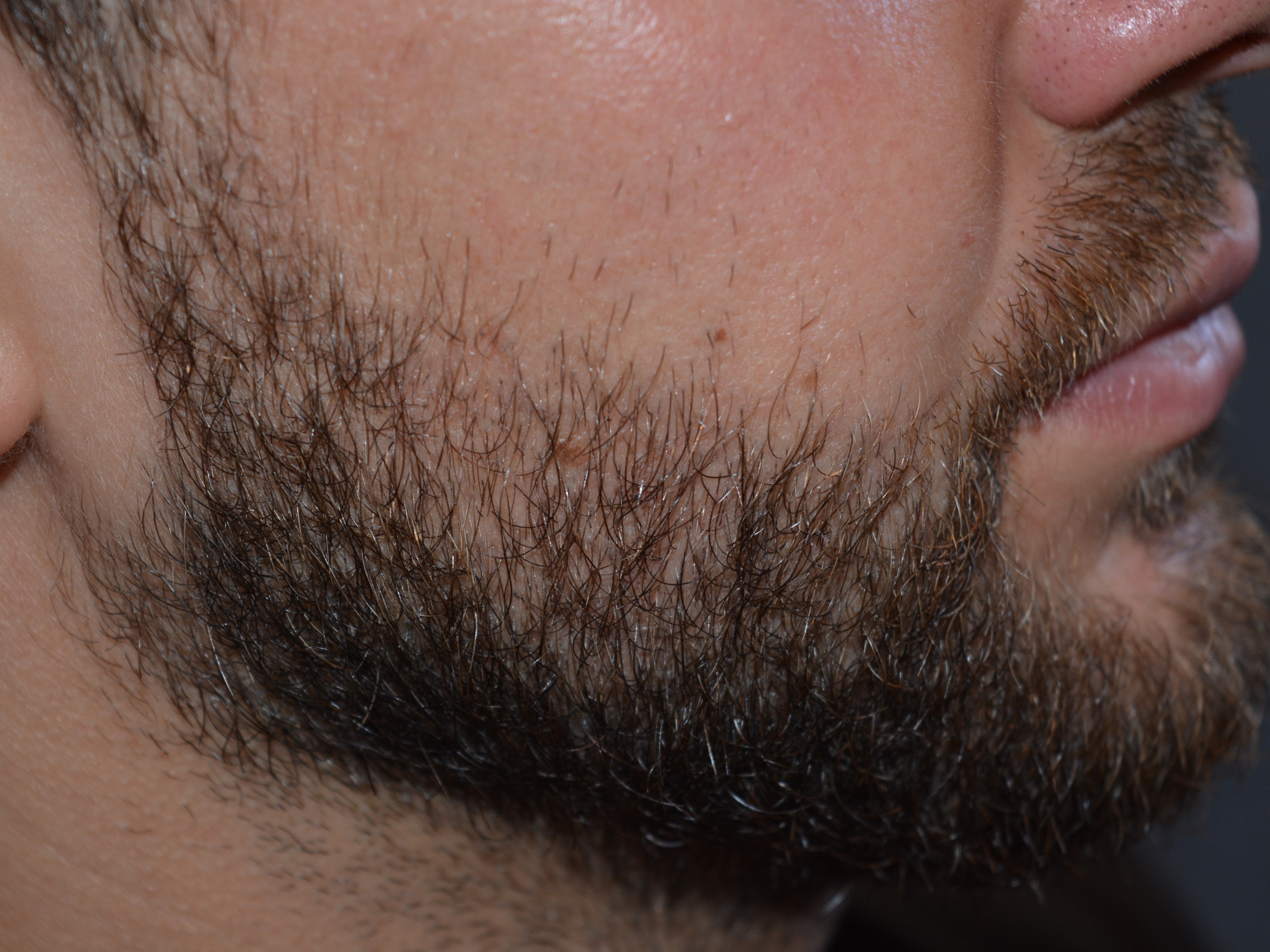 Patient 22 days after beard transplant