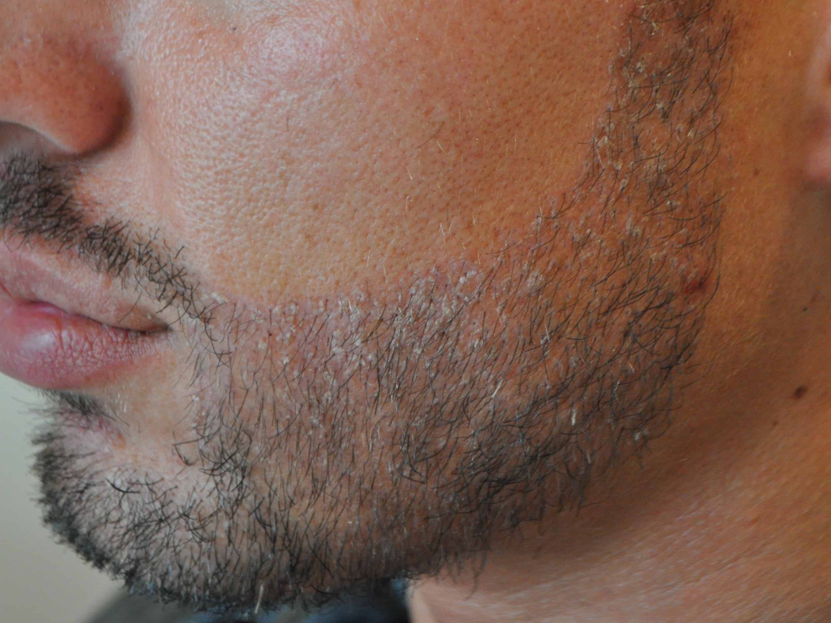 Patient 9 days after beard transplant