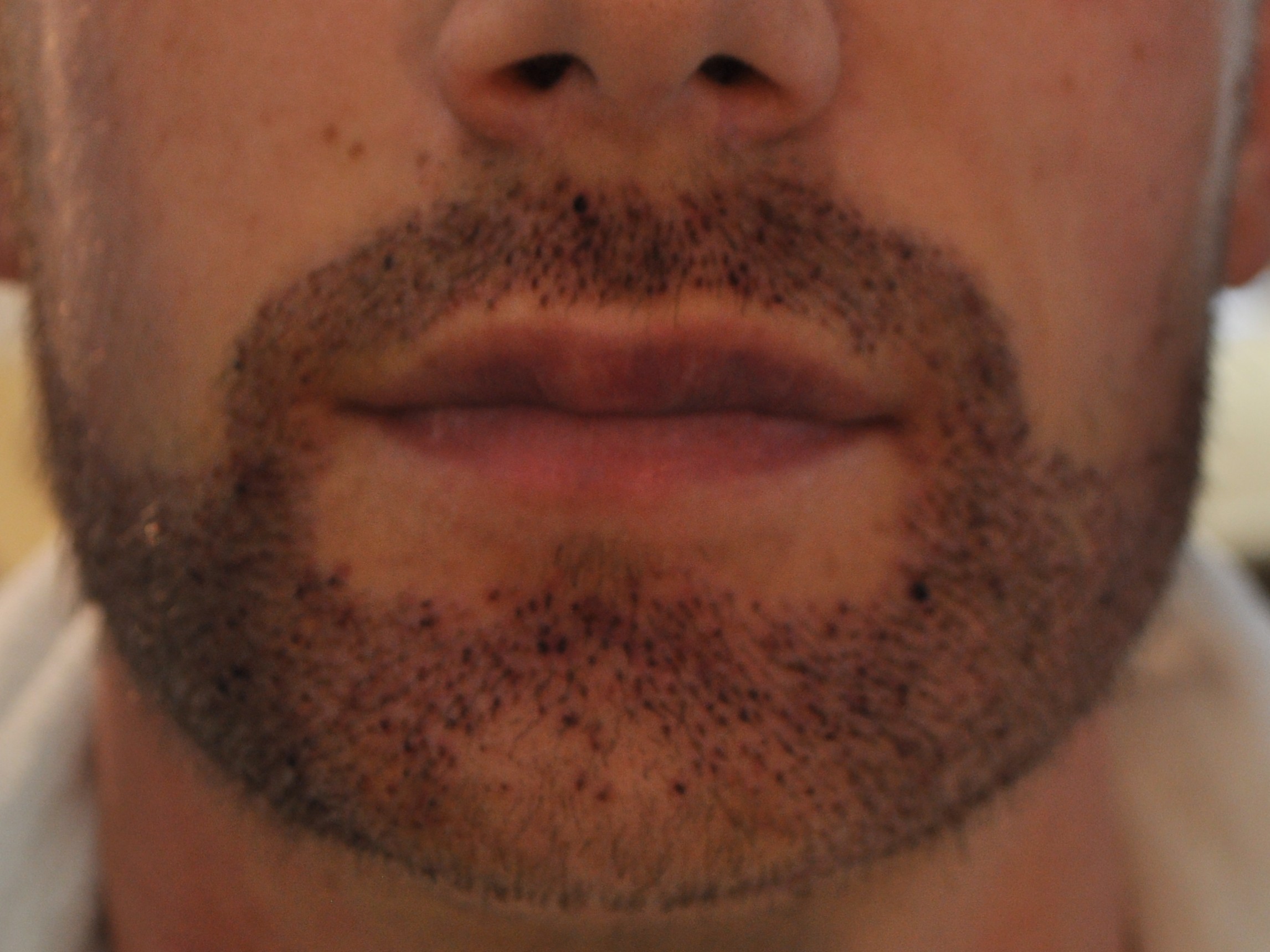 Patient's beard area 4 days after beard transplant