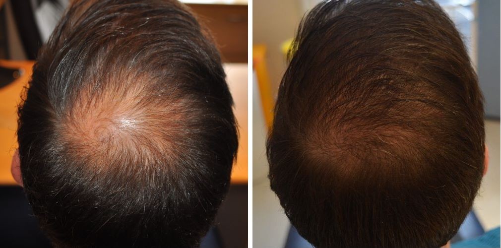 Patient’s crown before and 6 months after 2000 graft FUE hair transplant