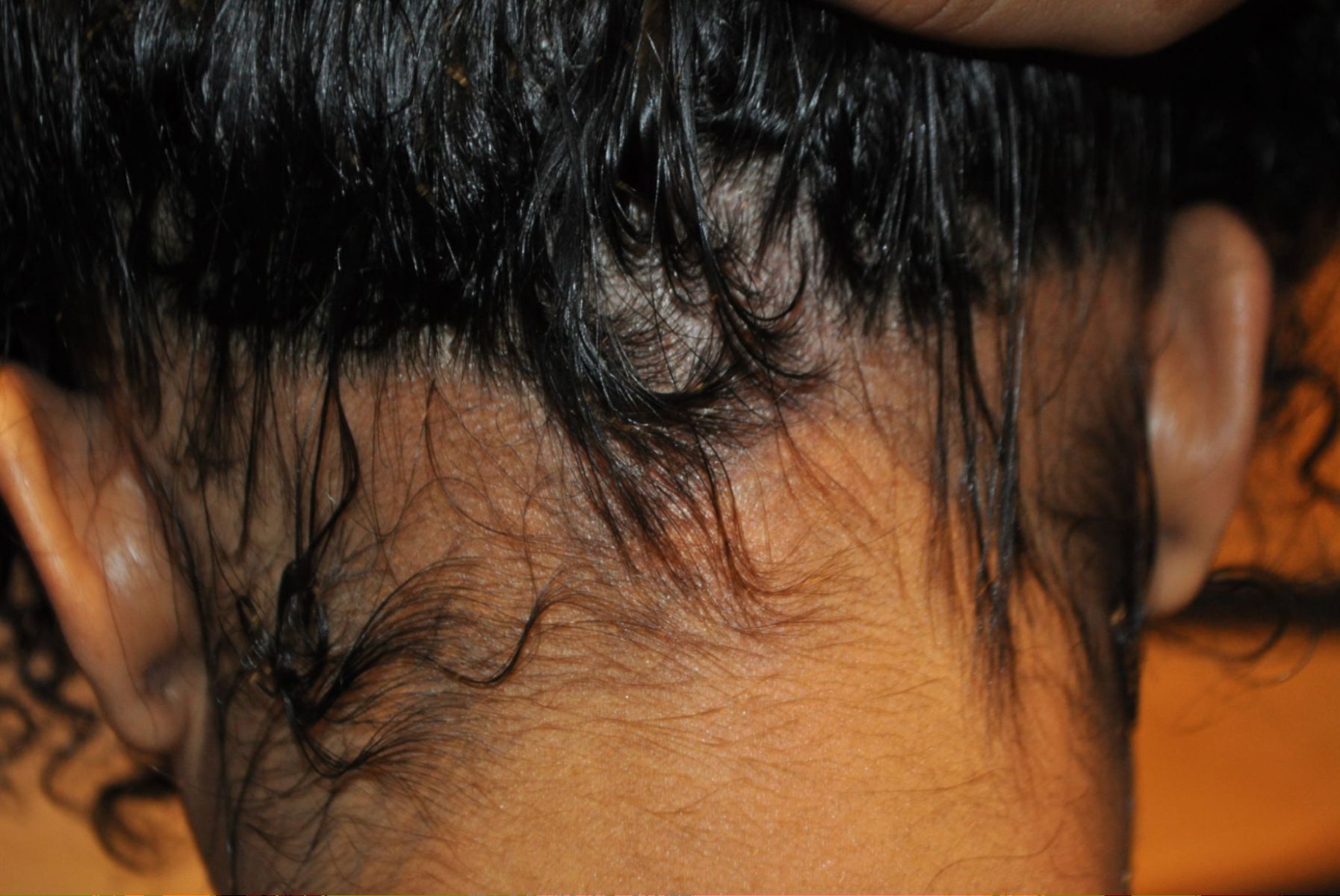 Wimpole Patient's traction alopecia on the back of the neck