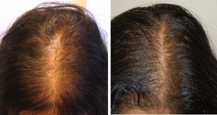 Wimpole patient before and after hair transplant for female pattern baldness