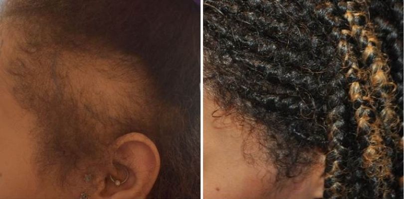 Wimpole patient before and after hair transplant for traction alopecia