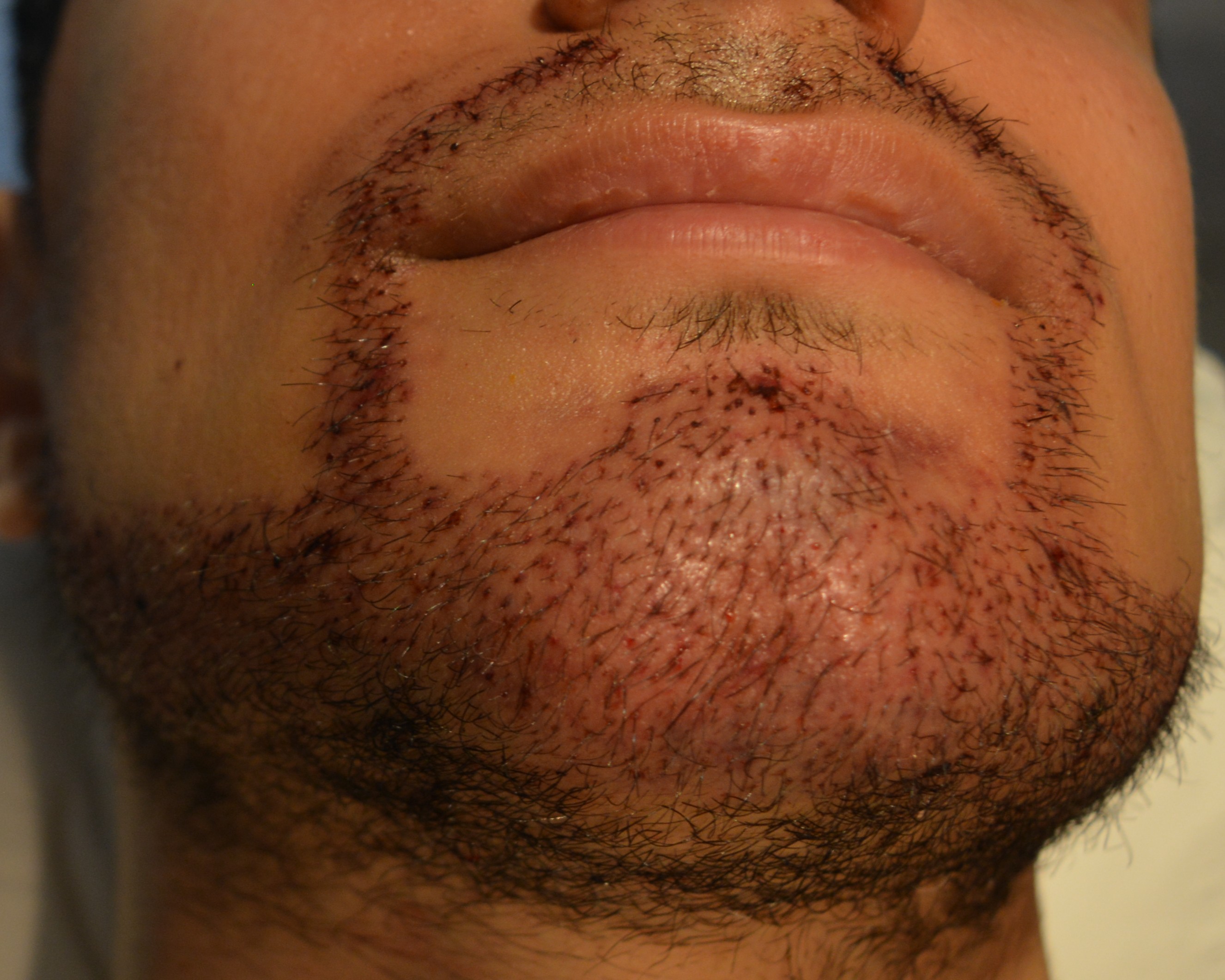 beard transplant 1 day after surgery