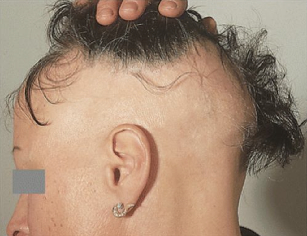 woman with ophiasis alopecia