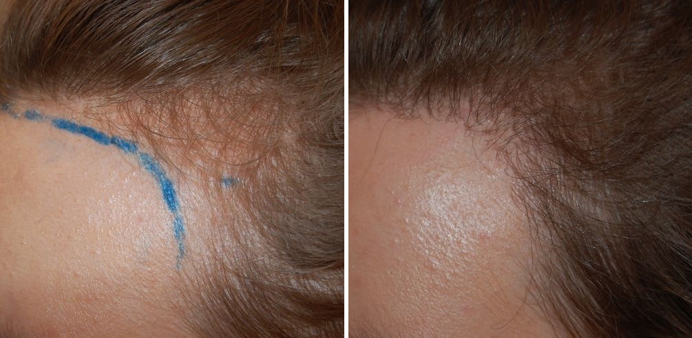 Female patient's temple before and 6 months after hair transplant at the Wimpole Clinic