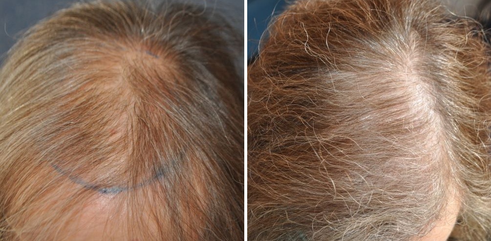 Female patient's top of head before and 6 months after hair transplant at the Wimpole Clinic
