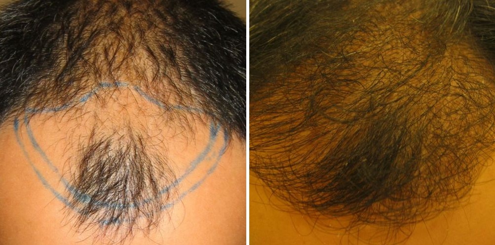 Hairline and mid-scalp before and 6 months after hair transplant at the Wimpole Clinic