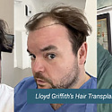 Lloyd Griffith’s Hair Transplant At The Wimpole Clinic: Results, Costs, Grafts