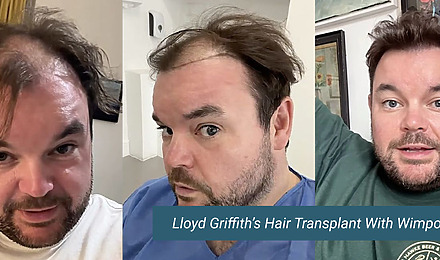 Hair transplant blog, Wimpole Clinic