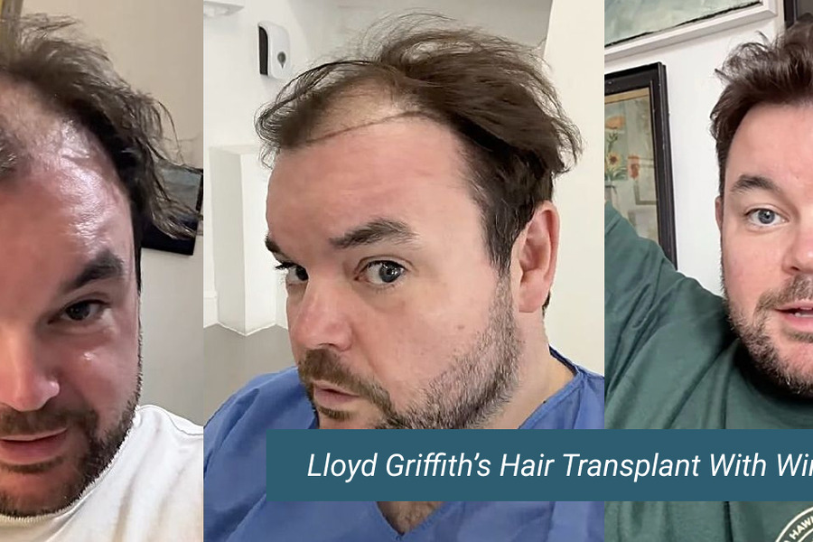 Lloyd Griffith Hair Transplant Wimpole Clinic