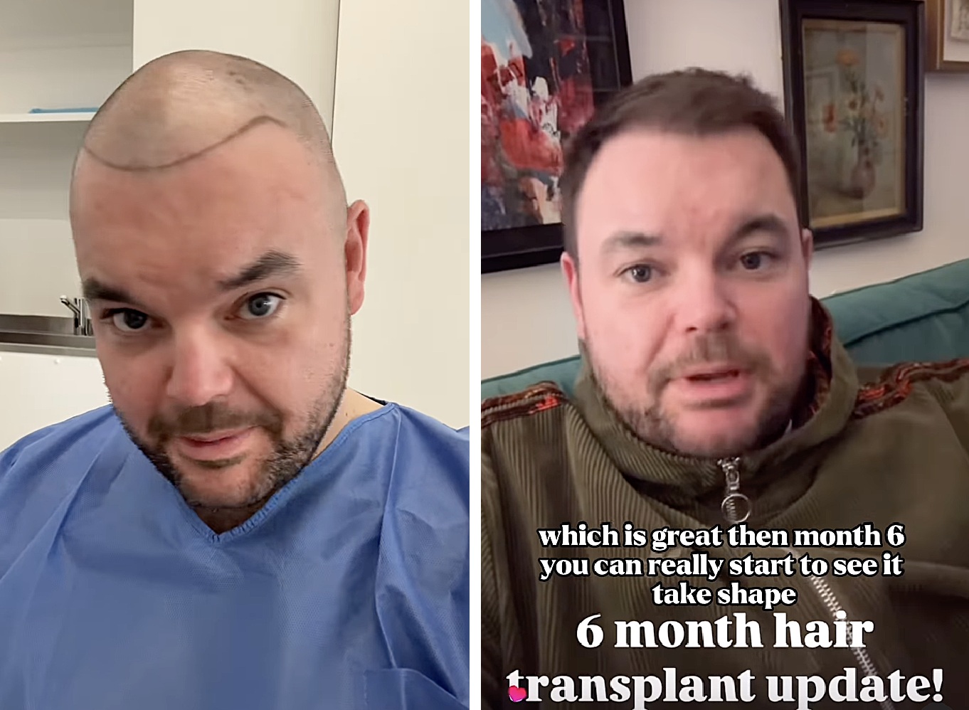 Lloyd Griffith before and 6 months after his hair transplant at the Wimpole Clinic