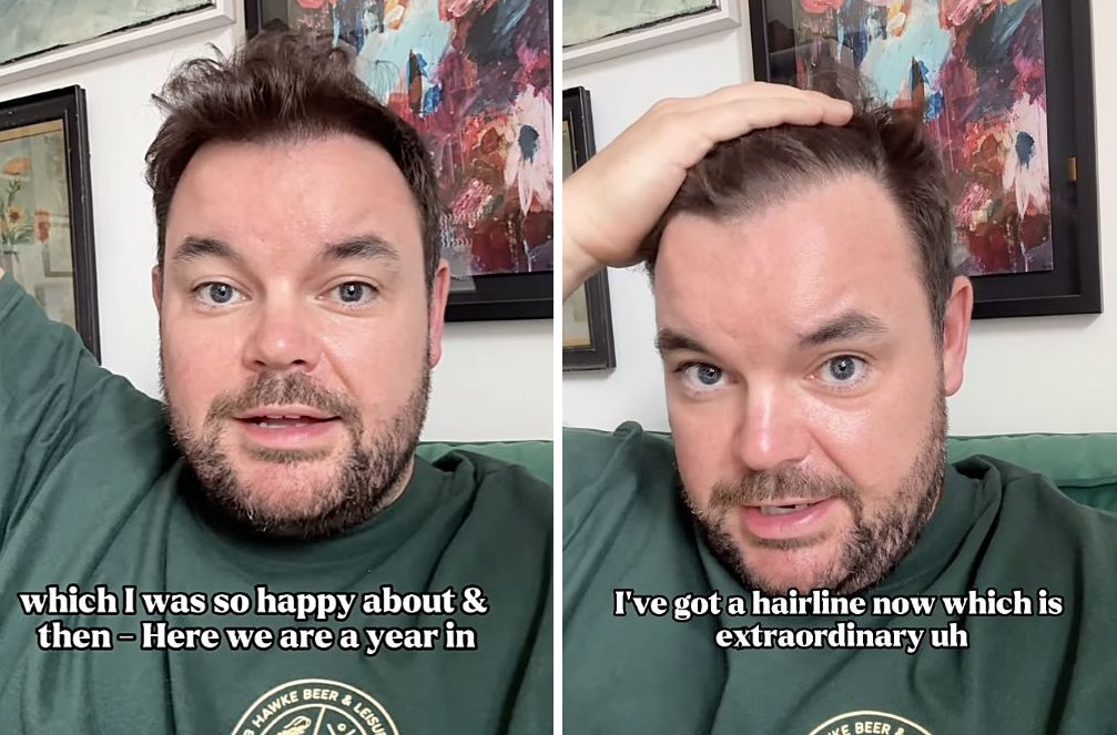 Lloyd Griffith final hair transplant results