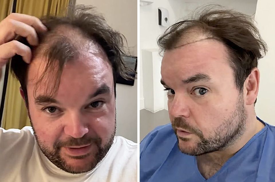 Lloyd Griffith's hair loss