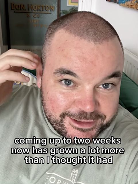 Lloyd Griffith's hair transplant after 12 days