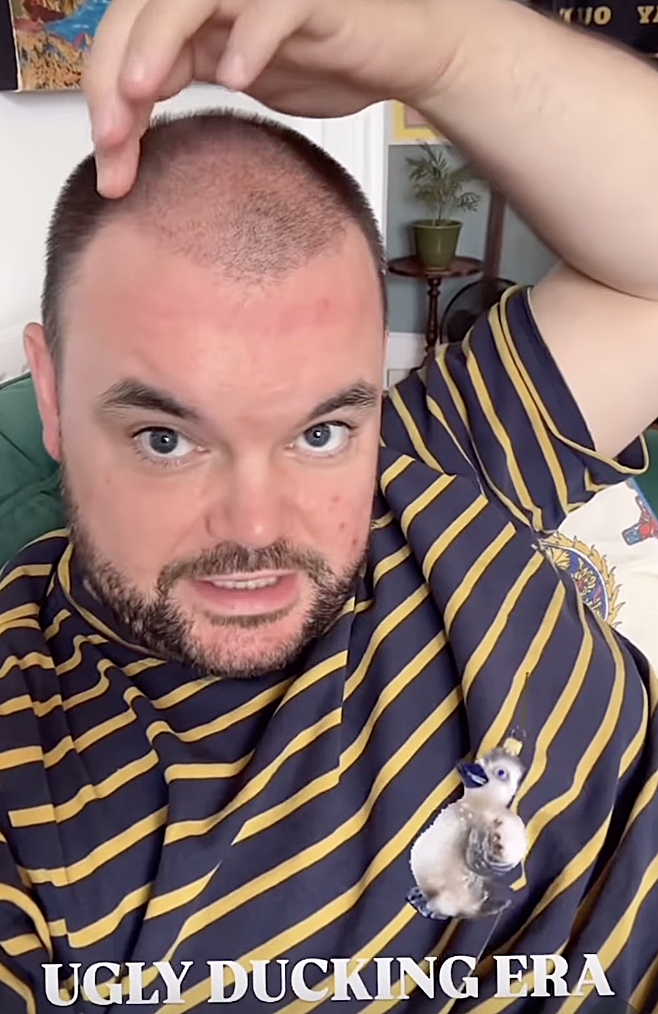 Lloyd Griffith's hair transplant in the ugly ducking phase