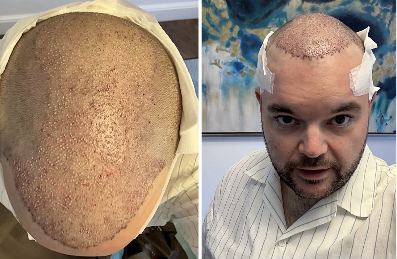 Lloyd Griffith's hair transplant the day of surgery