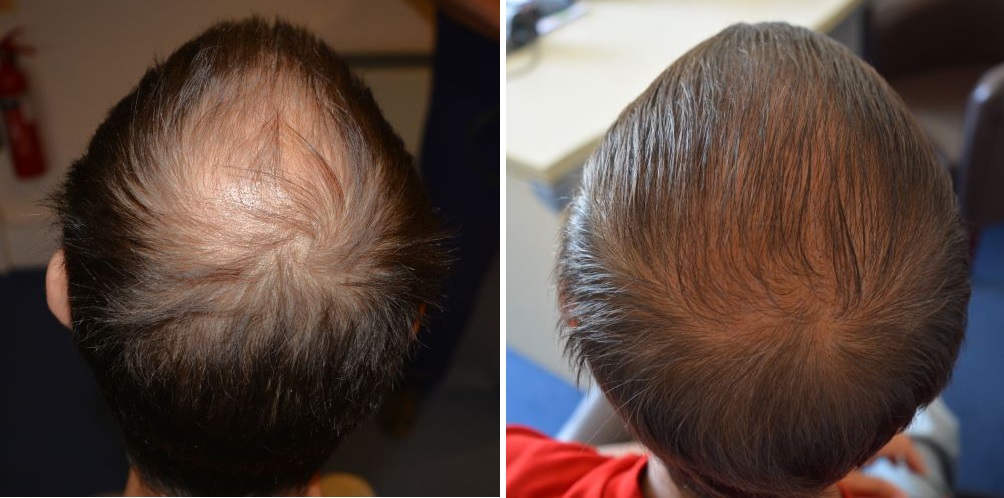 Patient's crown before and 6 months after hair transplant at the Wimpole Clinic