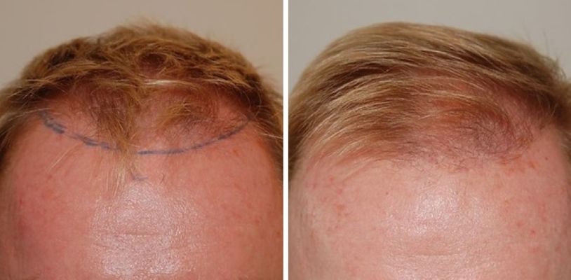 Patient's hairline before and 4 months after 1400 graft hair transplant