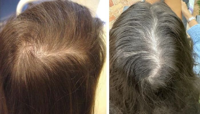 Telogen effluvium in female patients