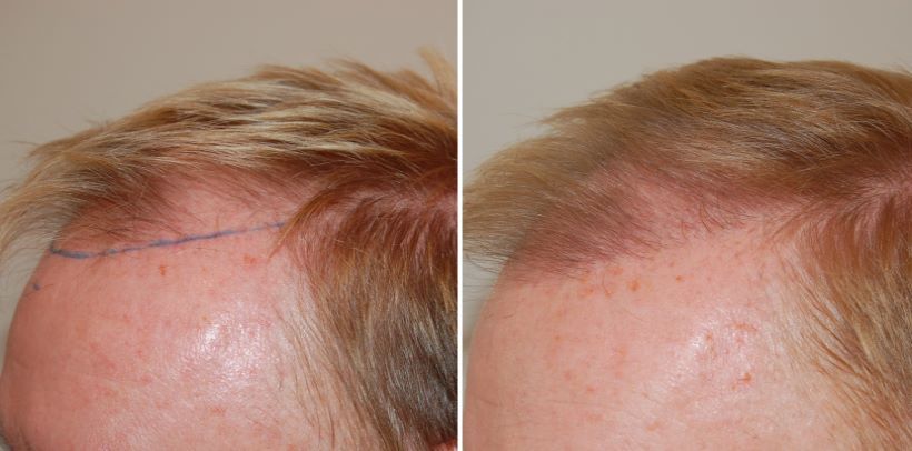 Temple and hairline before and 4 months after 1400 grafts FUT hair transplant
