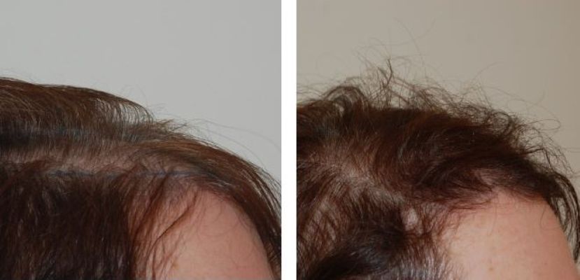 Temple and hairline before and 5 months after 1100 grafts FUT hair transplant in a female Wimpole patient