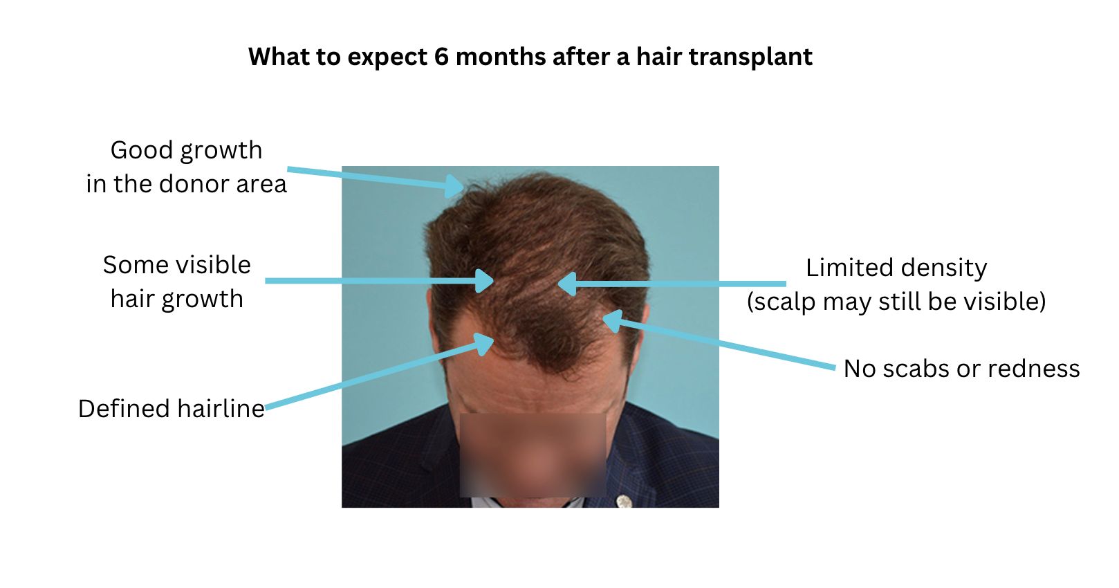 What to expect 6 months after a hair transplant