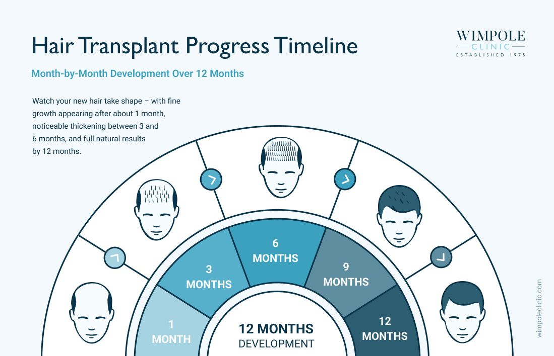 hair transplant progress timeline