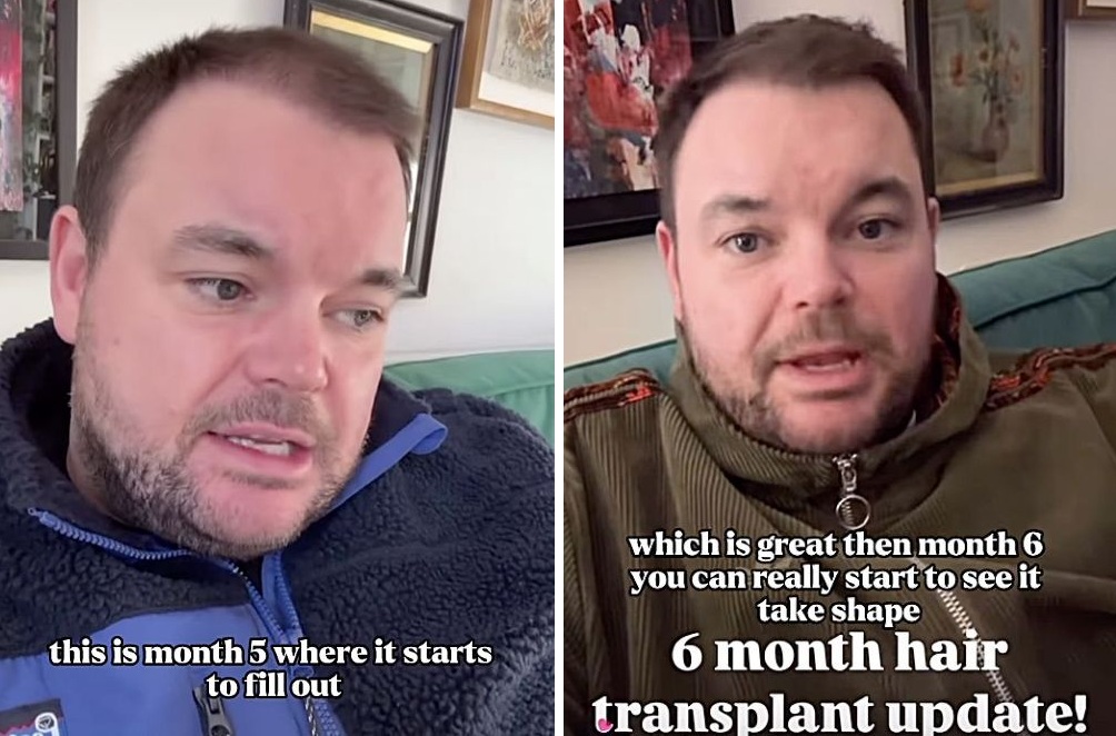 month 5-6 after Lloyd Griffith's hair transplant