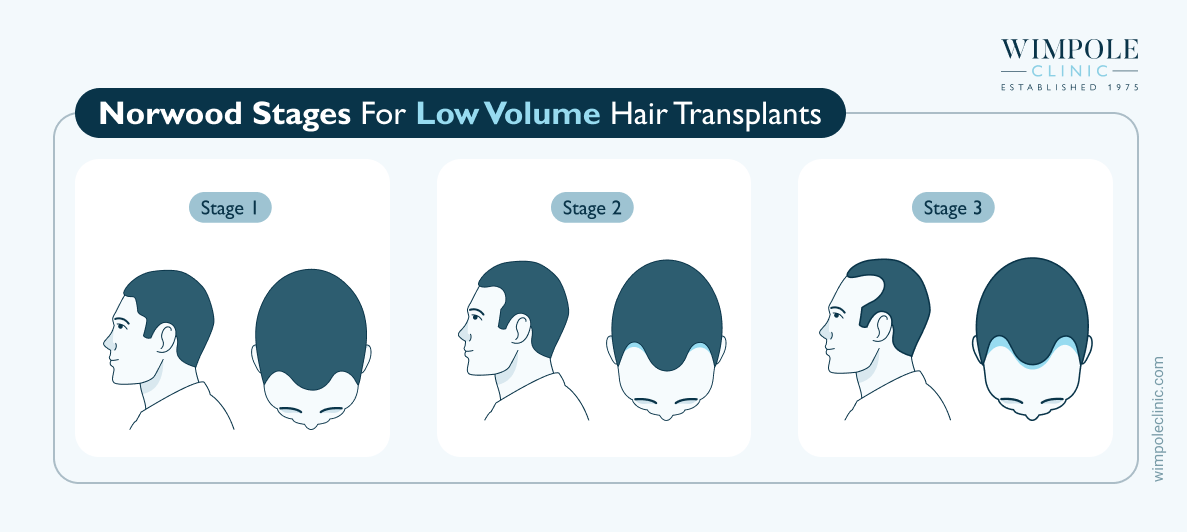 Norwood stages for low volume hair transplants