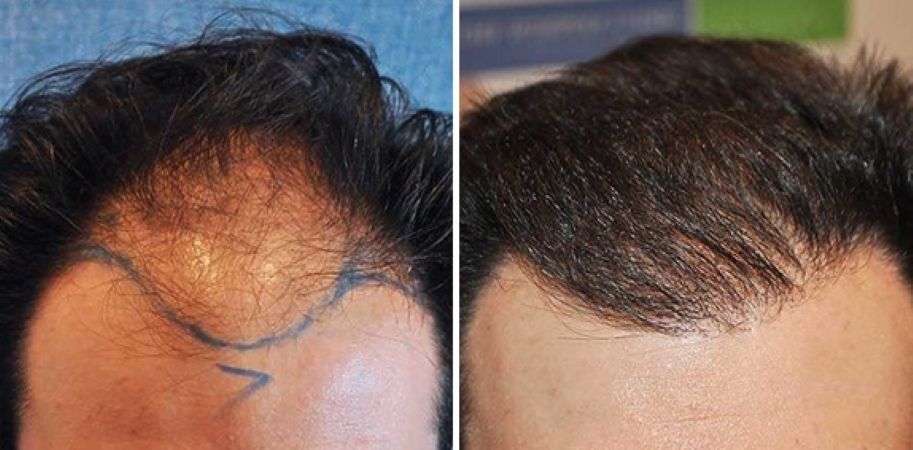 Patient before and 8 months after 2000 graft FUE hair transplant