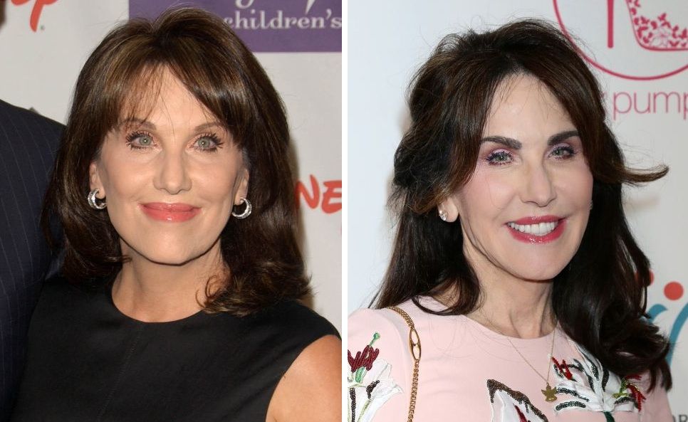 Robin McGraw eyebrow transplant