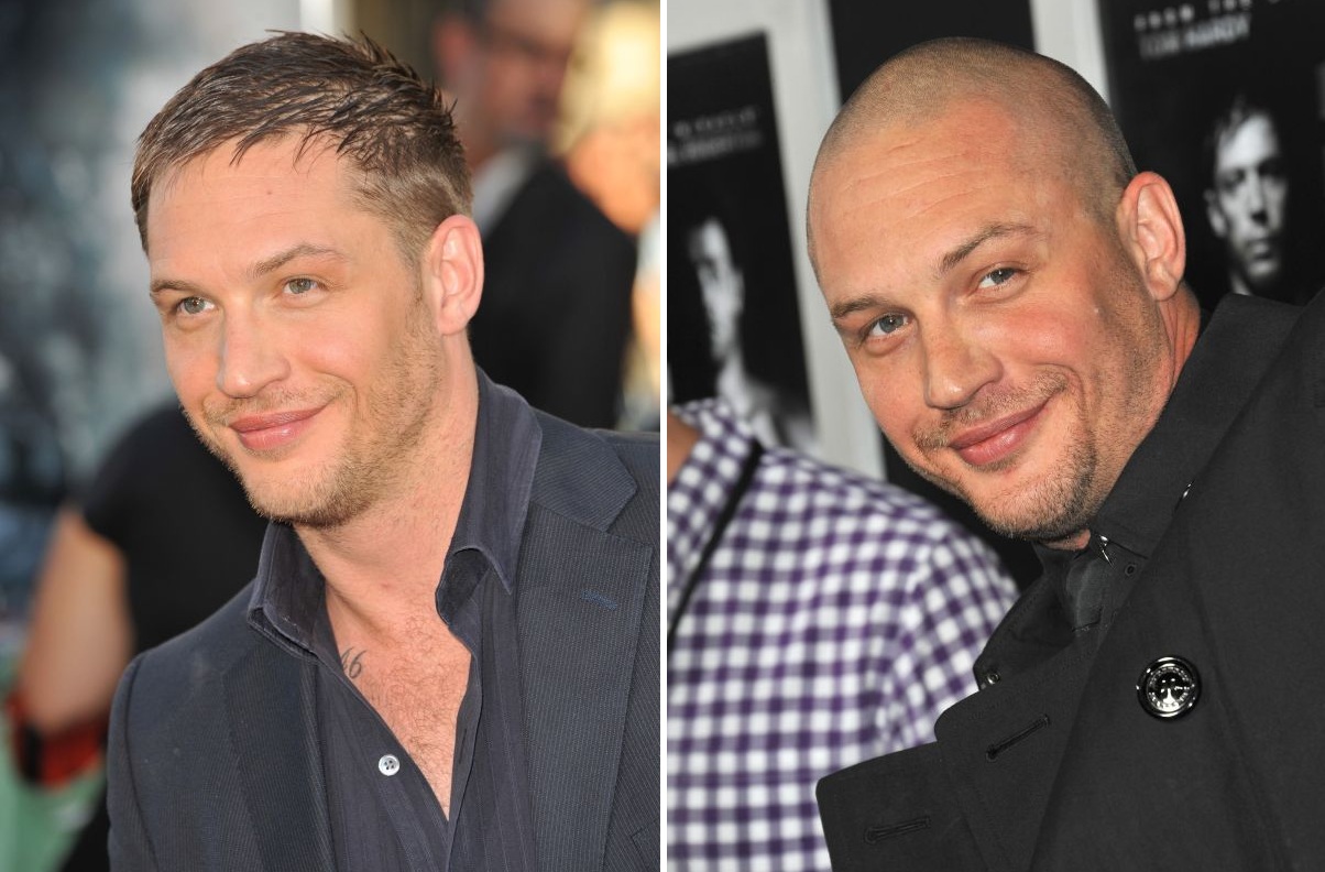 Tom Hardy Hair Transplant: Photos, Results, Timeline, Wimpole Clinic